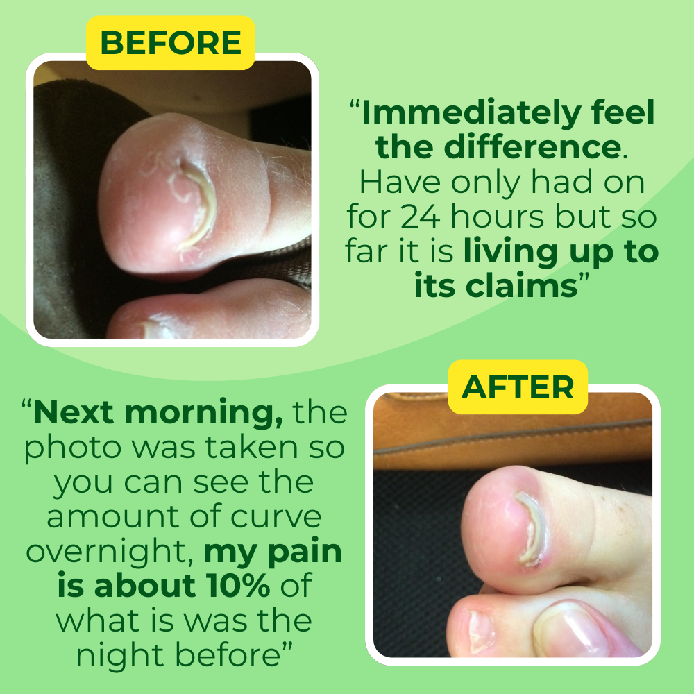 Ingrown Toenail Home Relief Treatment Kit