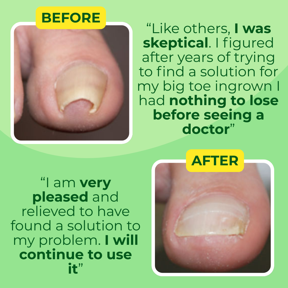 Ingrown Toenail Home Relief Treatment Kit