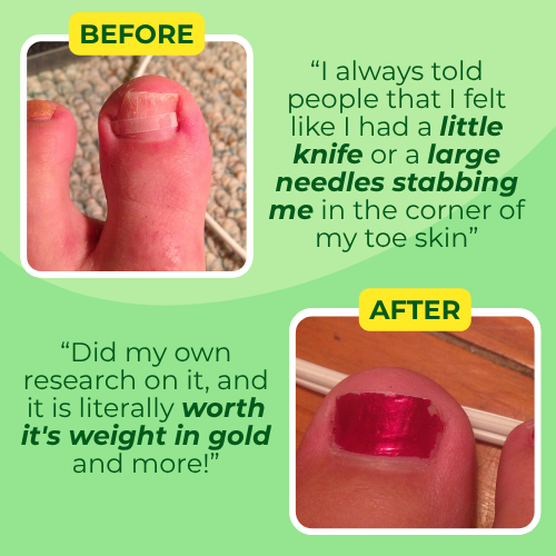 Ingrown Toenail Home Relief Treatment Kit