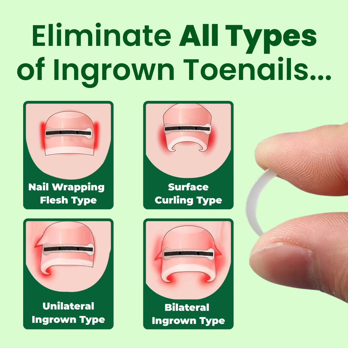 Ingrown Toenail Home Relief Treatment Kit