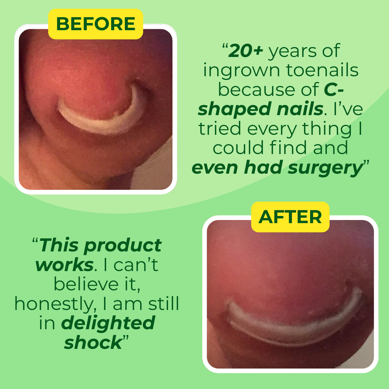 Ingrown Toenail Home Relief Treatment Kit