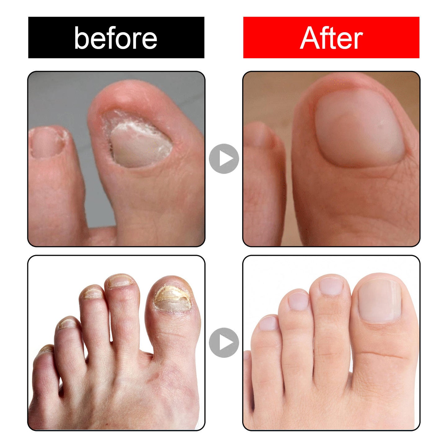 Ingrown Toenail Drops Pain Relief & Soften Nail