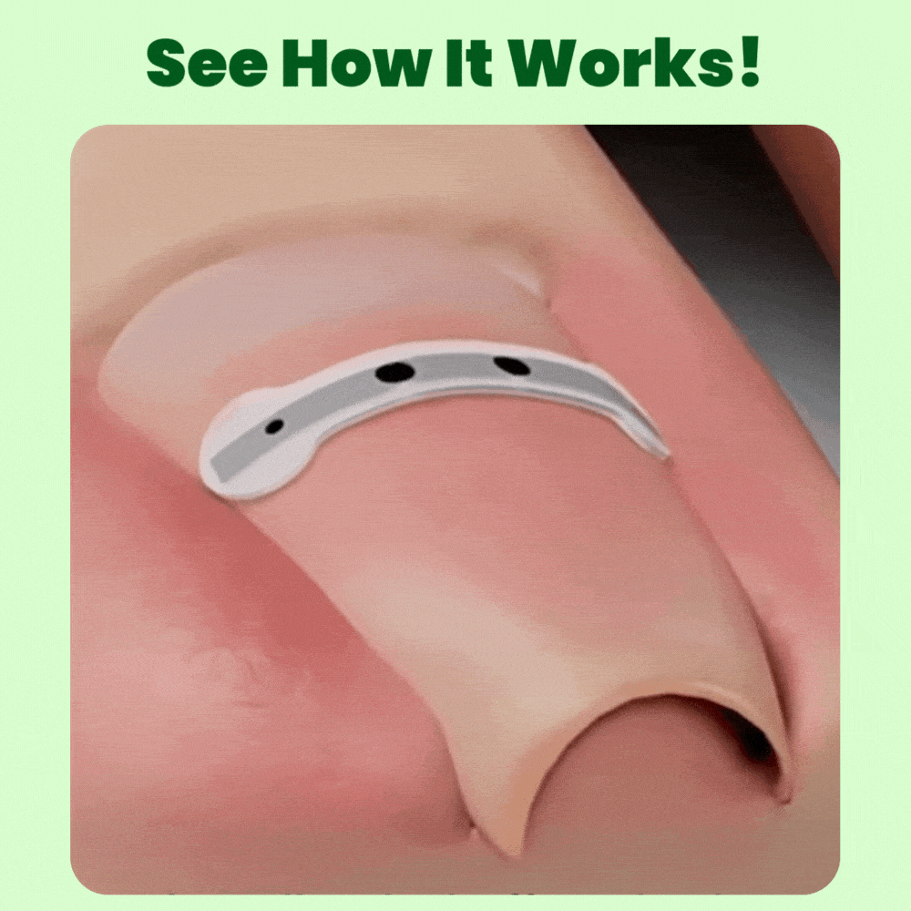 Ingrown Toenail Home Relief Treatment Kit