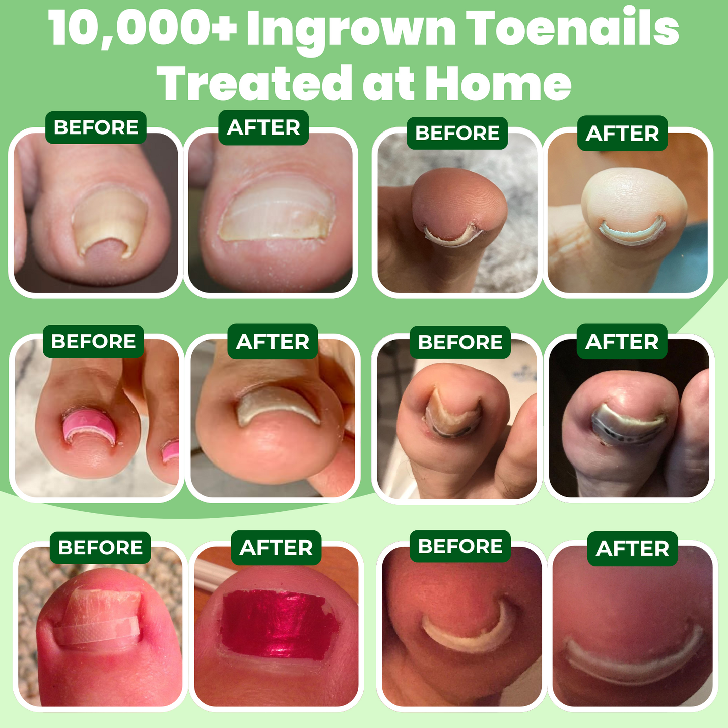 Ingrown Toenail Home Relief Treatment Kit