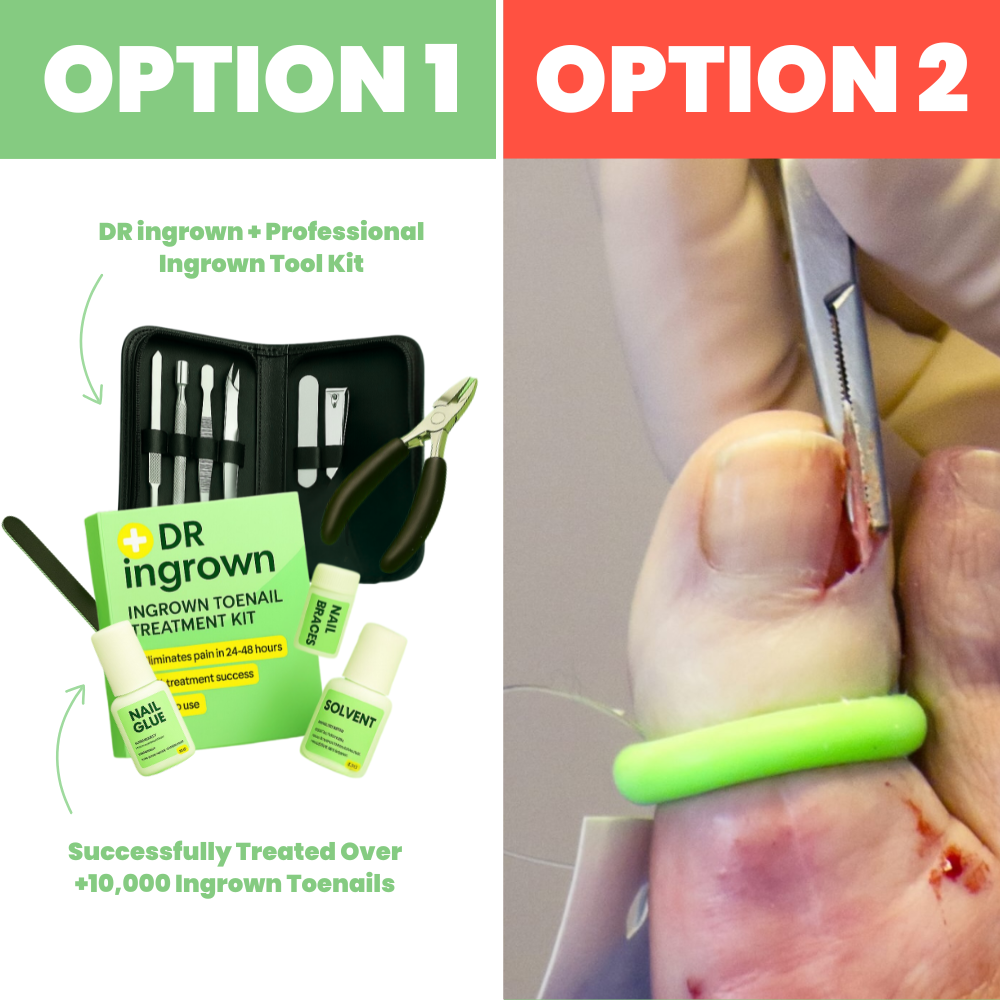 Ingrown Toenail Home Relief Treatment Kit