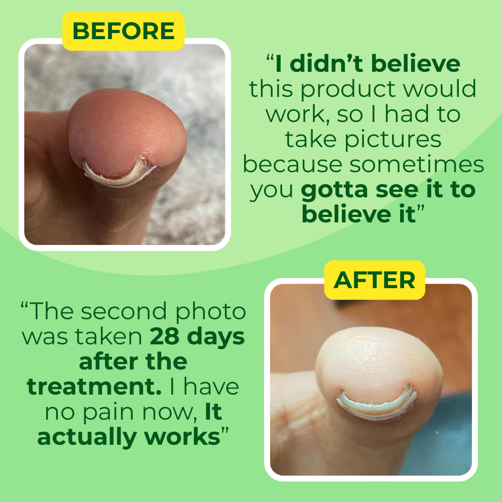 Ingrown Toenail Home Relief Treatment Kit
