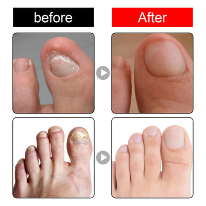 Ingrown Toenail Drops Pain Relief & Soften Nail