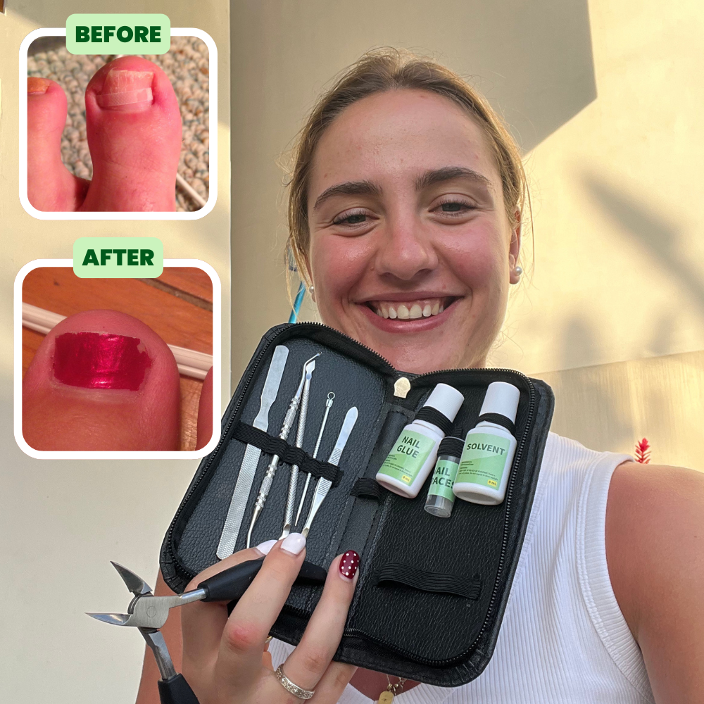 Ingrown Toenail Home Relief Treatment Kit