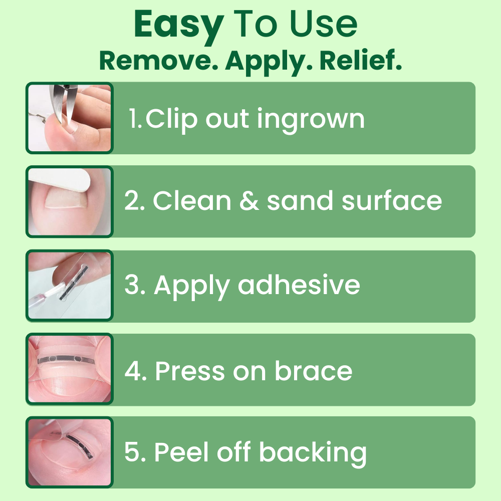 Ingrown Toenail Home Relief Treatment Kit