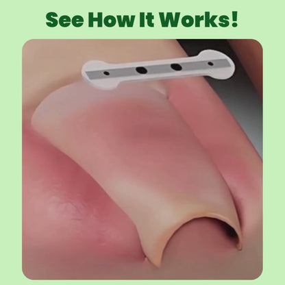 Ingrown Toenail Home Relief Treatment Kit