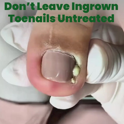 Ingrown Toenail Home Relief Treatment Kit